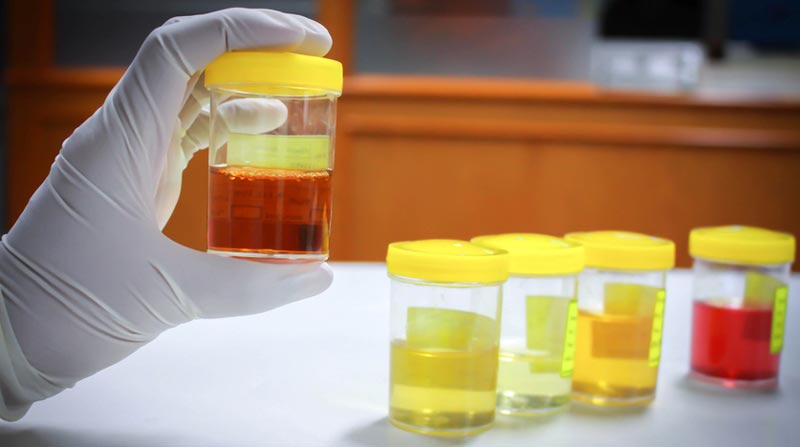 ادرار تیره رنگ نشانه چیست؟