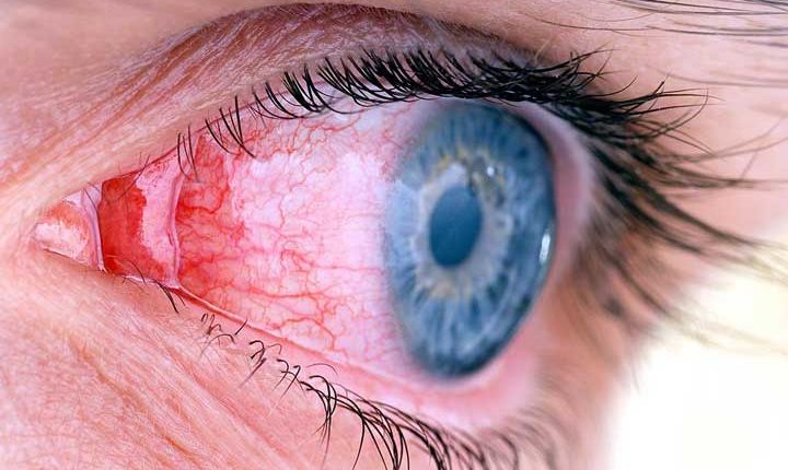 تاثیرالتهاب روده بر التهاب چشم