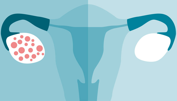سندرم تخمدان پلی کیستیک چیست؟