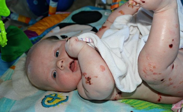 بیماری پروانه ای در نوزادان 