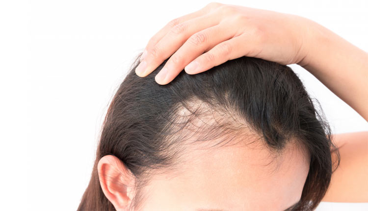 مزایا و معایب کاشت مو به روش prp