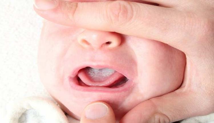 تشخیص برفک دهان نوزاد با مشاهده زبان